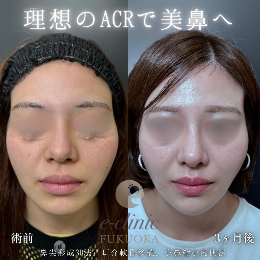 鼻尖形成と軟骨移植と小鼻縮小の症例写真 (13)