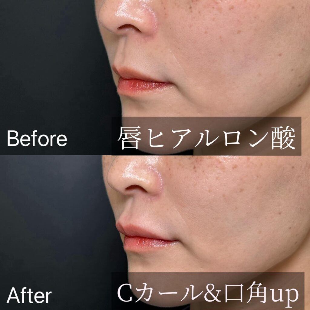 唇のヒアルロン酸の症例写真 (20)