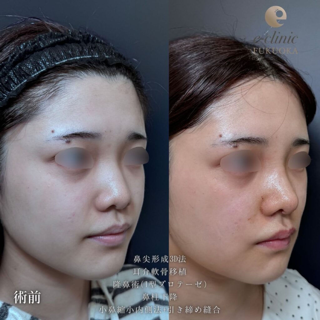 鼻尖形成と軟骨移植とプロテーゼと鼻柱下降と小鼻縮小と頬と顎下の脂肪吸引とバッカルファットと糸リフトの症例写真 (2)