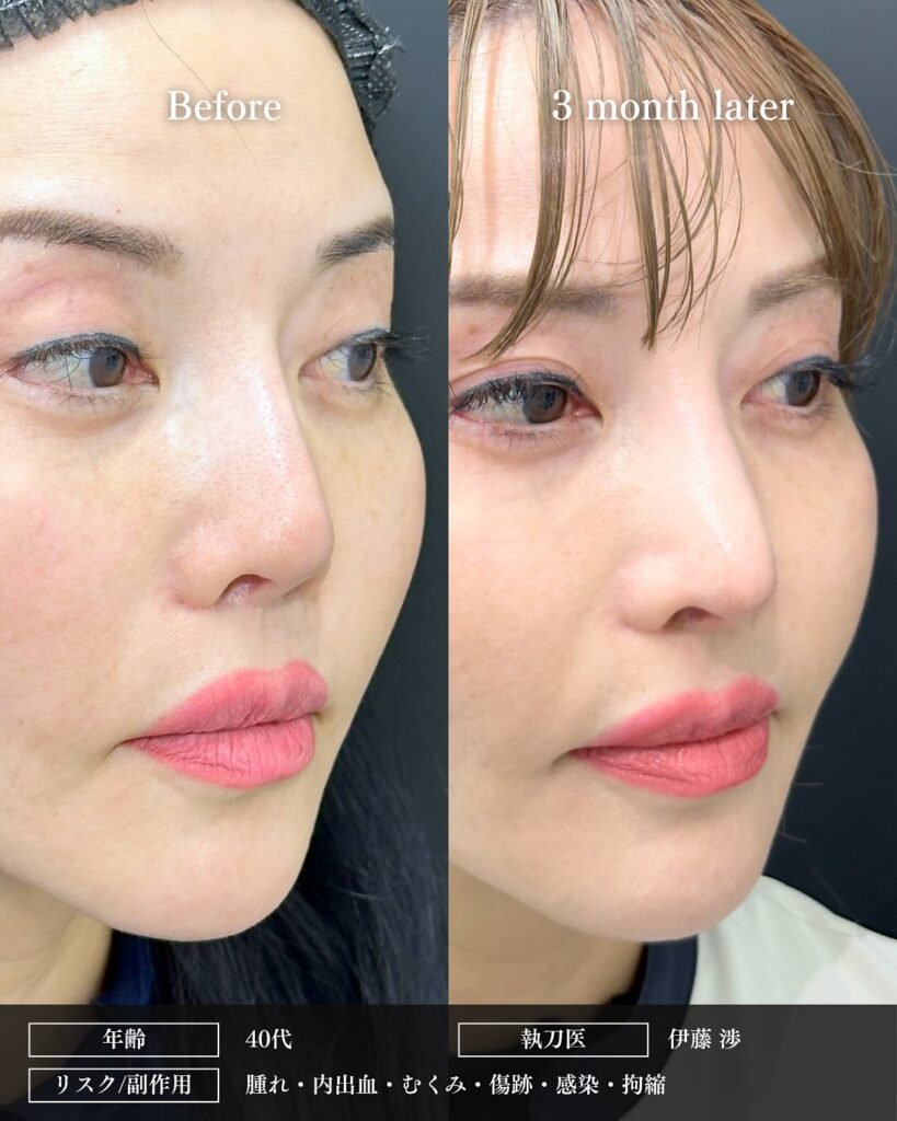 鼻尖形成と軟骨移植とプロテーゼ入れ替えの症例写真 (4)