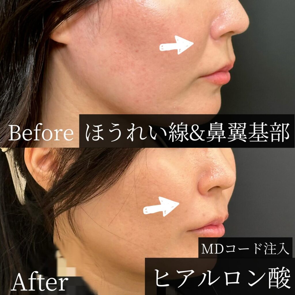法令線のヒアルロン酸の症例写真 (13)