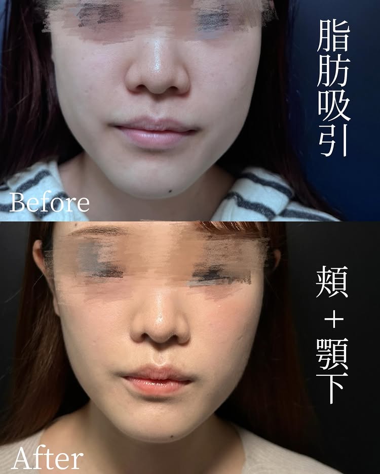 頬と顎下の脂肪吸引の症例写真 (1)