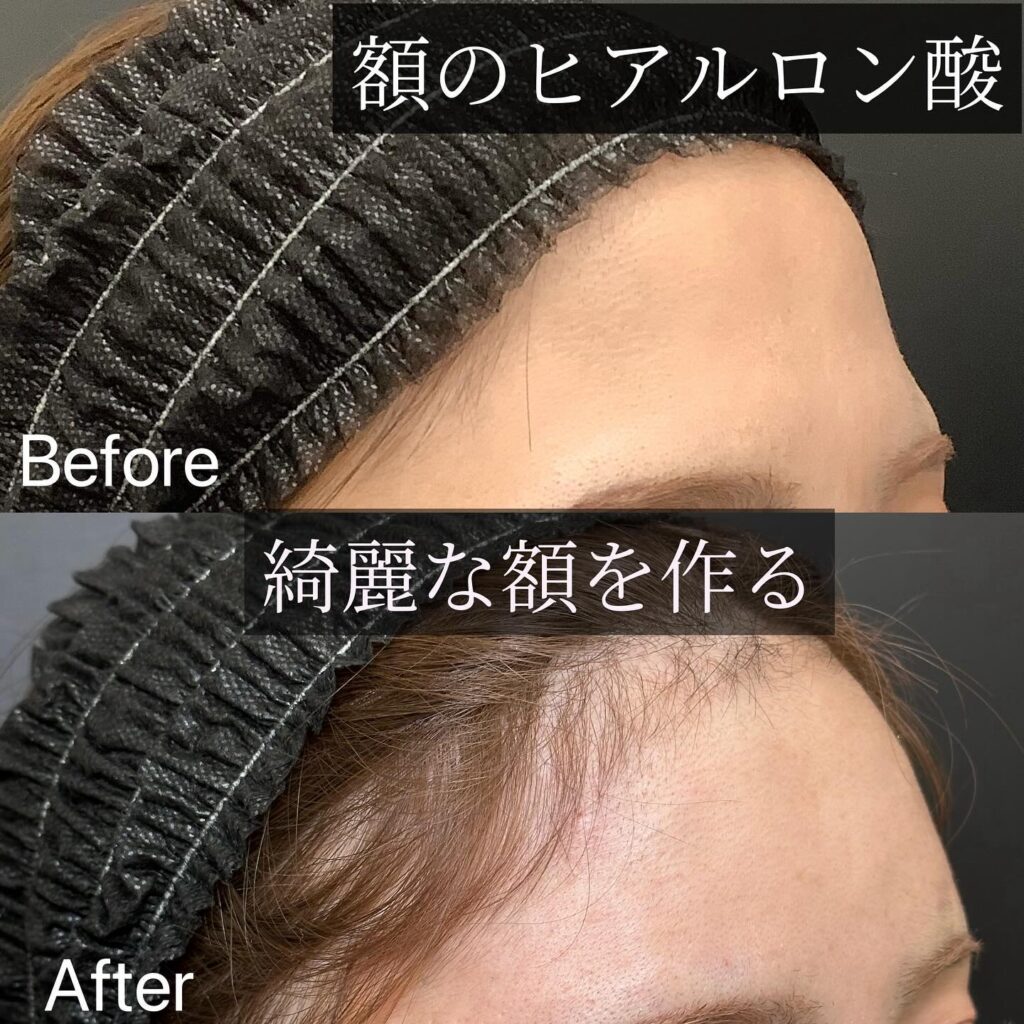 額のヒアルロン酸注入の症例写真 (1)