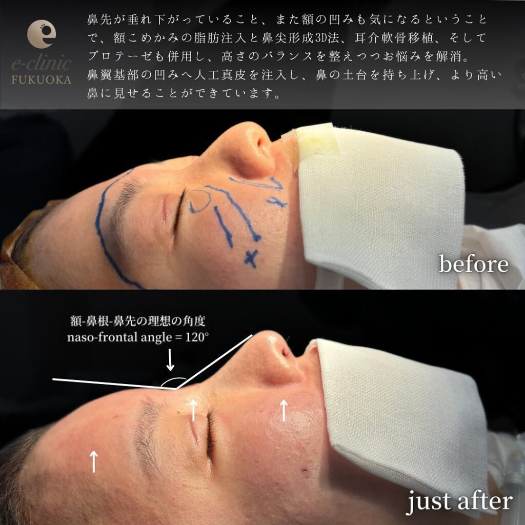 鼻尖形成と軟骨移植とプロテーゼと額とこめかみの脂肪注入と人工真皮の症例写真 (1)