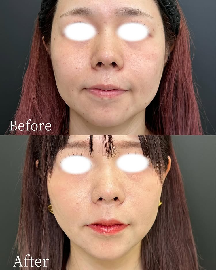 頬と顎下の脂肪吸引の症例写真 (4)