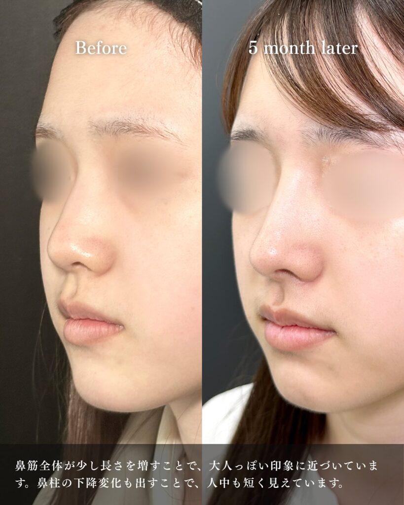 鼻中隔延長と鼻尖形成と耳介軟骨とプロテーゼと小鼻縮小と小鼻ボトックスの症例写真 (6)
