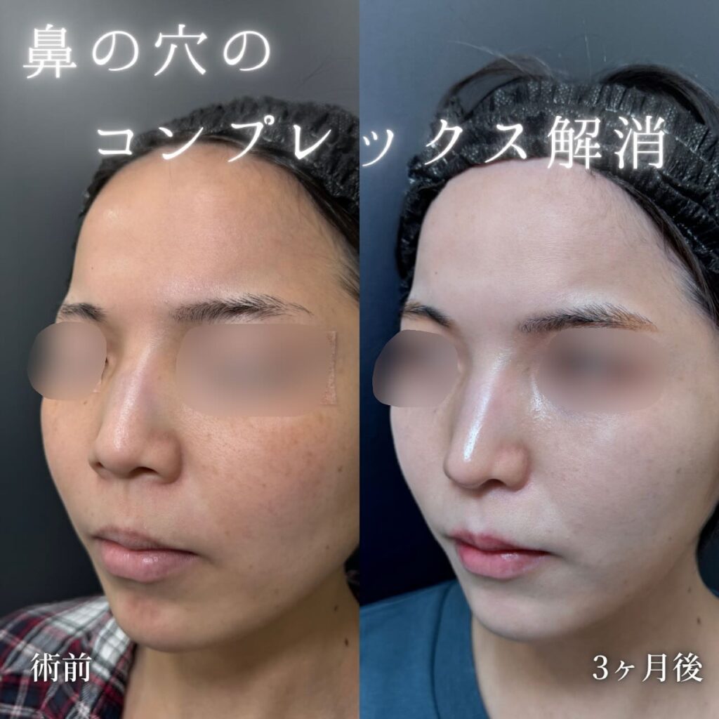 鼻尖形成と軟骨移植と鼻柱下降と小鼻縮小の症例写真 (7)