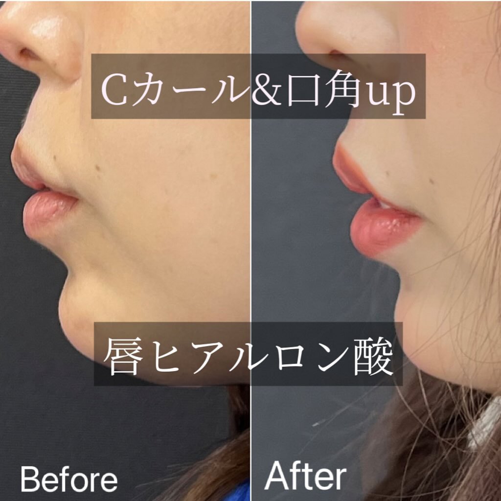 唇のヒアルロン酸の症例写真 (18)