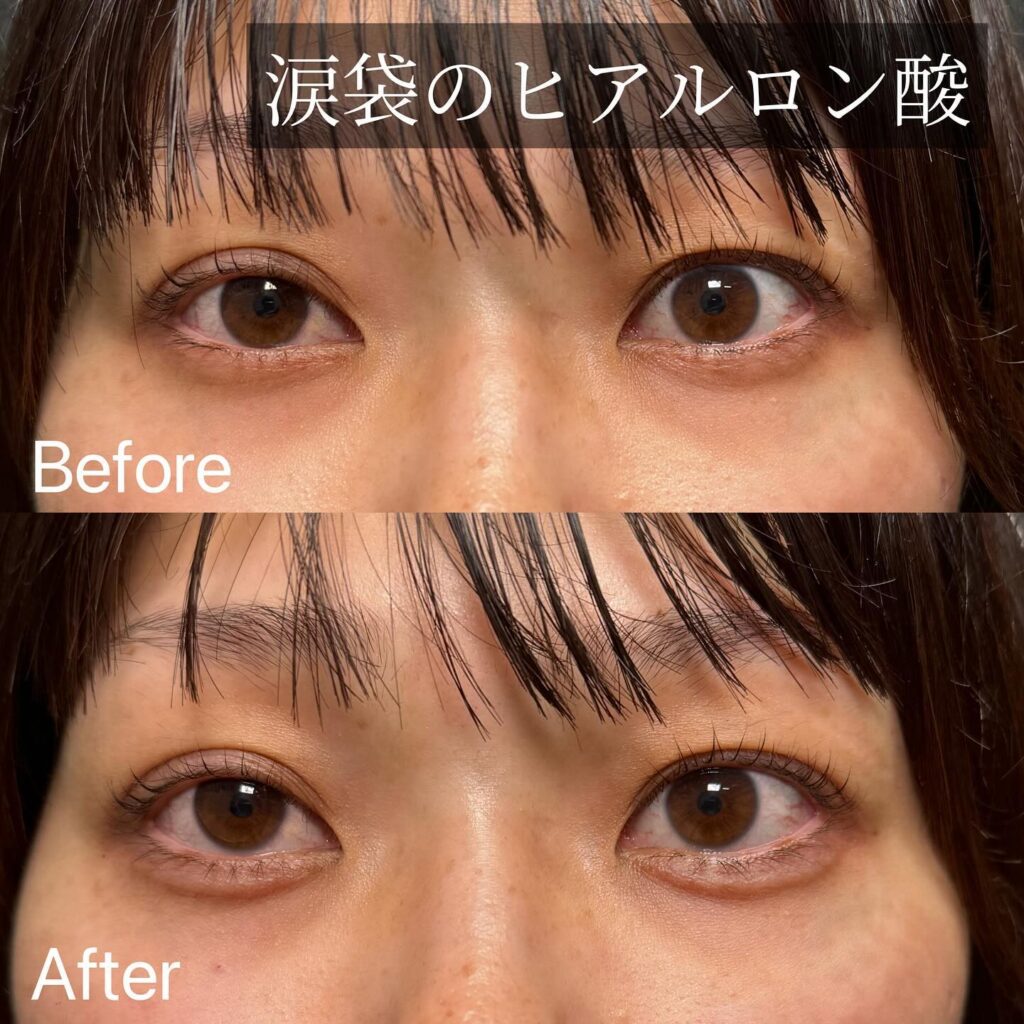 涙袋のヒアルロン酸の症例写真 (5)