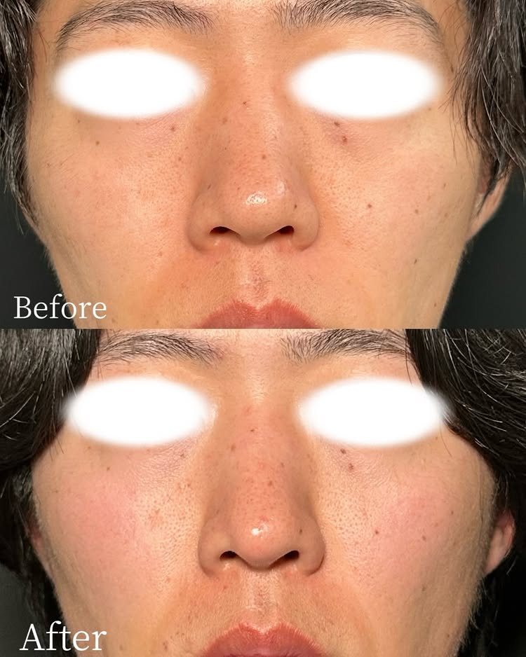 鼻尖形成と軟骨移植症例写真 (2)