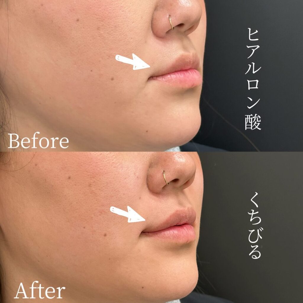 唇のヒアルロン酸の症例写真 (33)