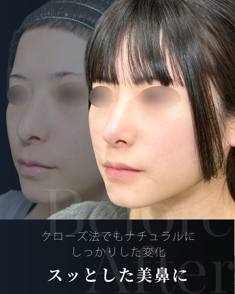 鼻尖形成と軟骨移植の症例写真 (36)