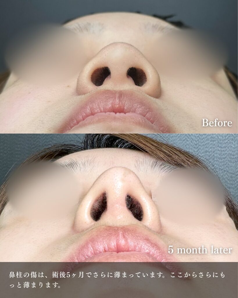 鼻中隔延長と鼻尖形成と耳介軟骨とプロテーゼと小鼻縮小と小鼻ボトックスの症例写真 (5)
