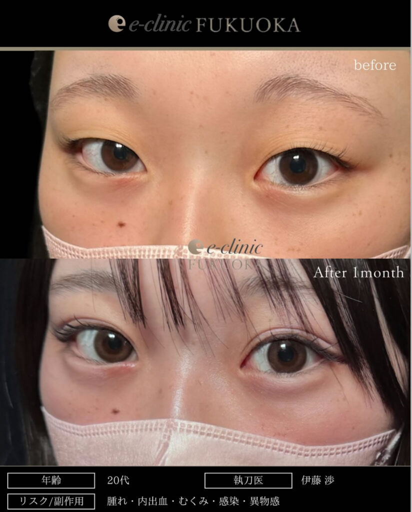 自然癒着法の症例写真