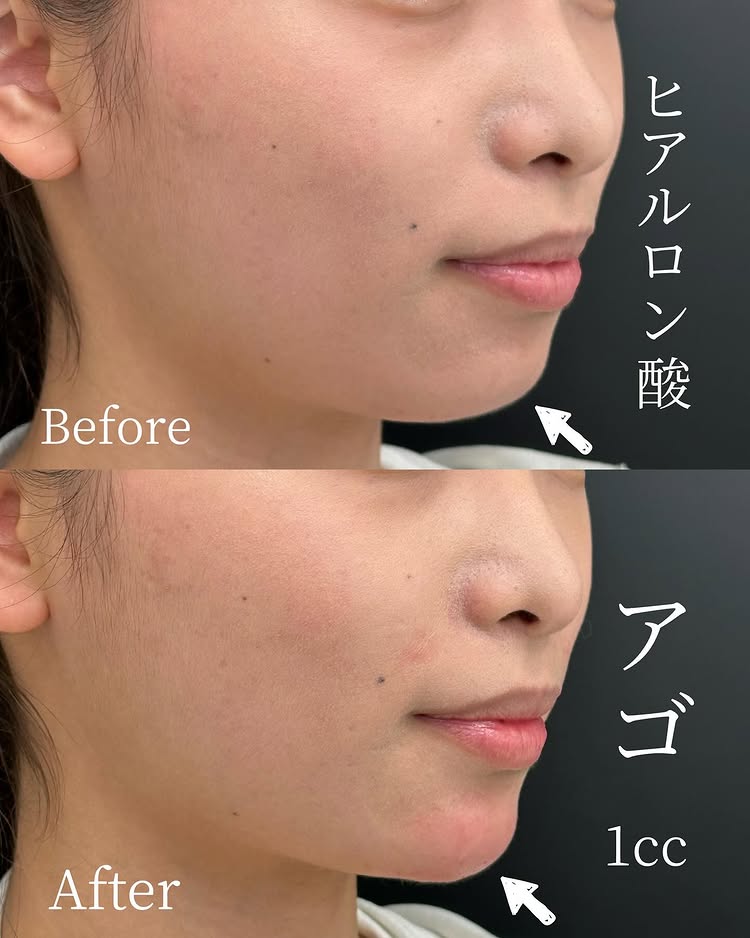 顎のヒアルロン酸の症例写真 (23)