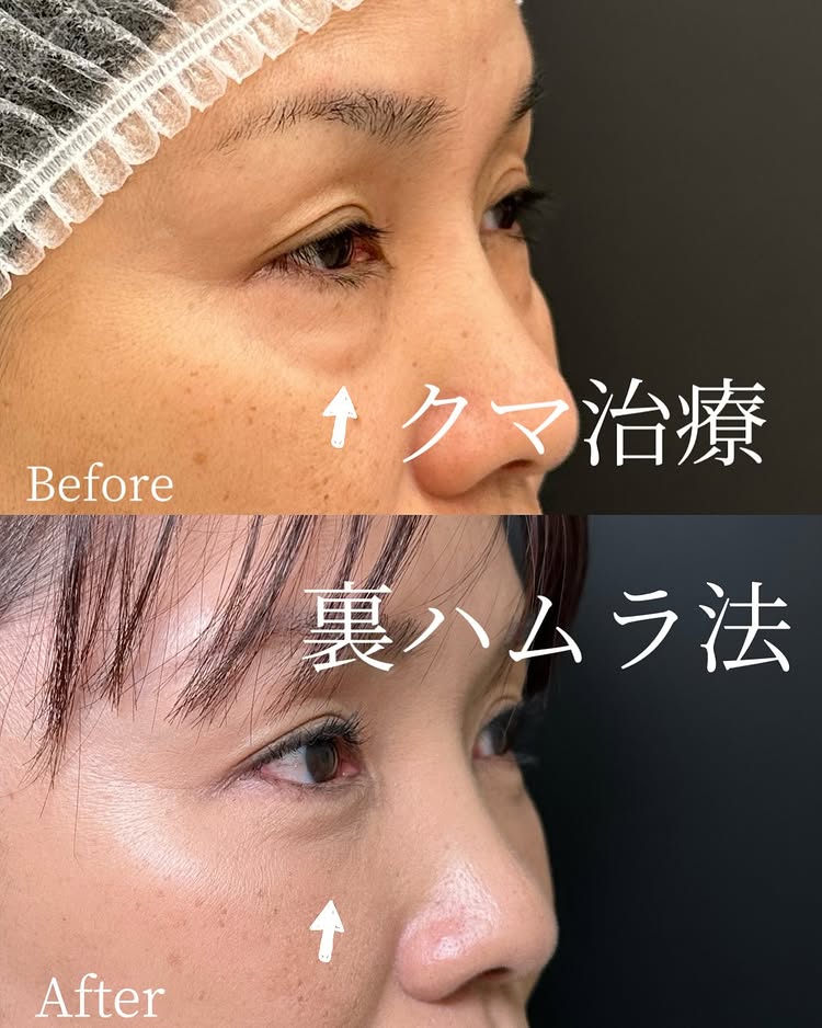 裏ハムラ法の症例写真 (91)