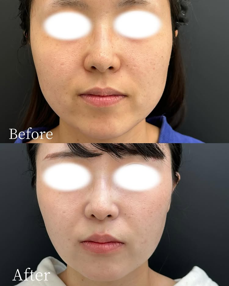 頬の脂肪吸引の症例写真 (2)