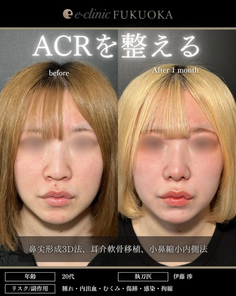 鼻尖形成と軟骨移植と小鼻縮小の症例写真 (27)