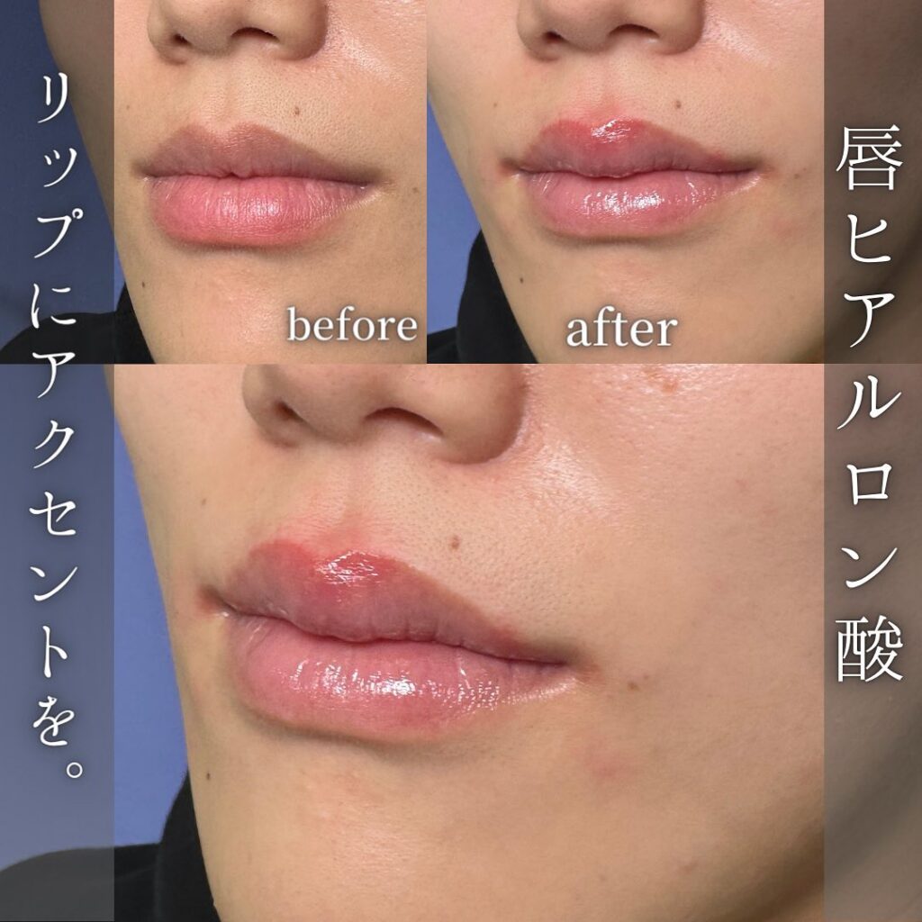 唇のヒアルロン酸の症例写真 (13)
