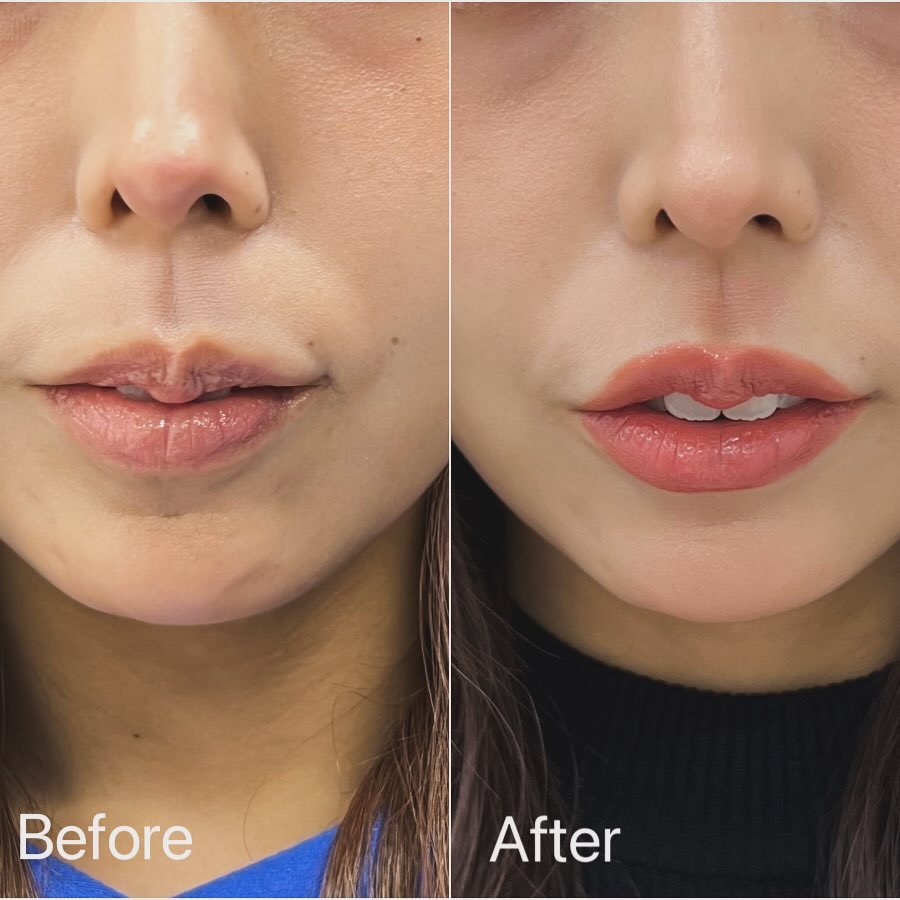 唇のヒアルロン酸の症例写真 (13)