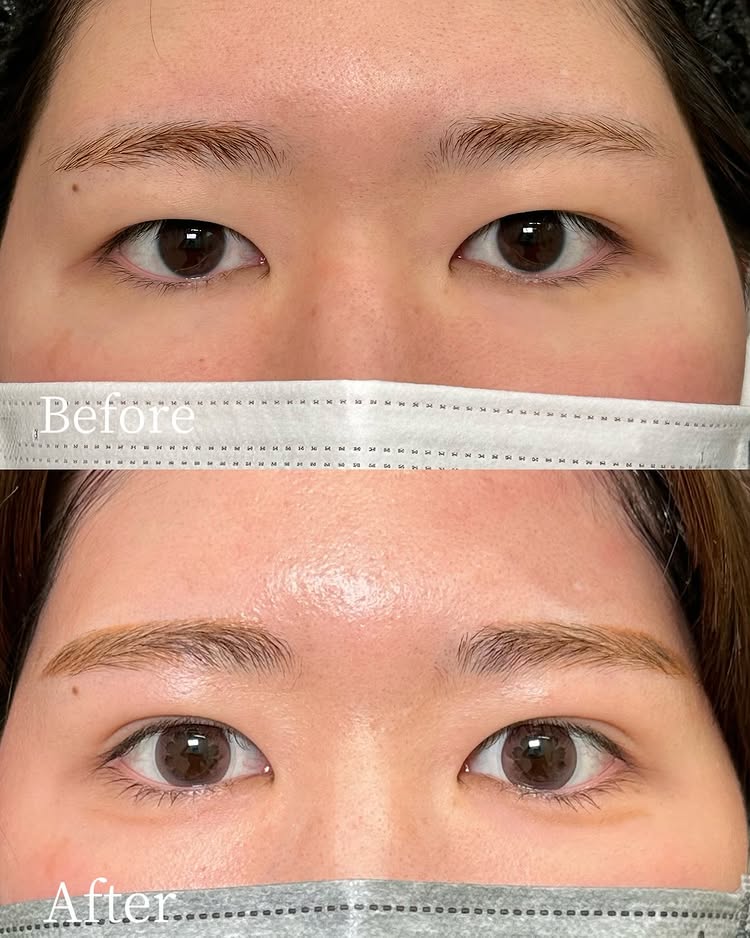 自然癒着法の症例写真 (16)