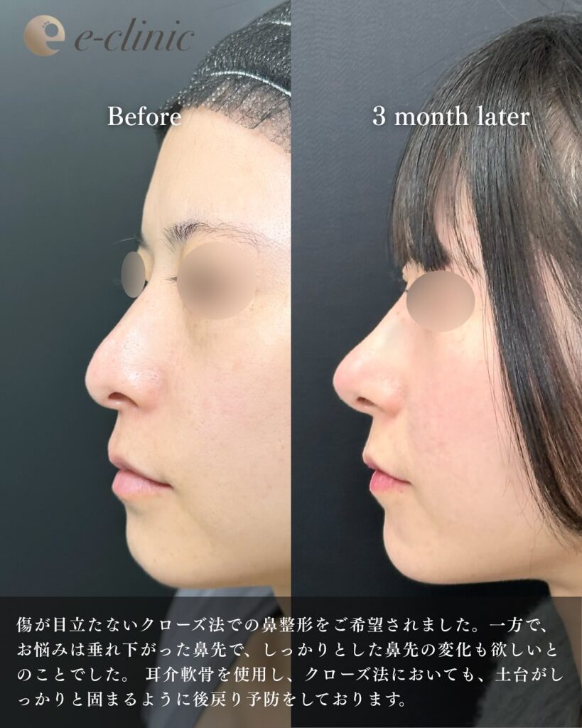 鼻尖形成+軟骨移植の症例写真 (1)