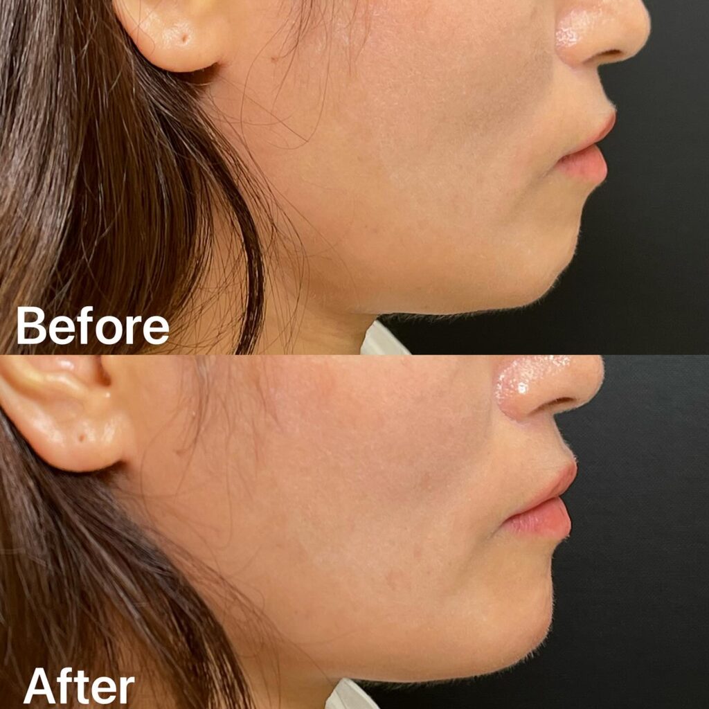 顎のヒアルロン酸の症例写真 (10)