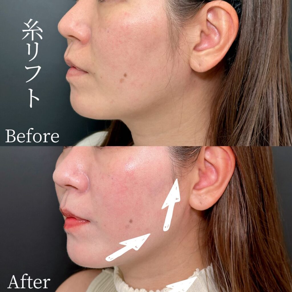 糸リフトの症例写真 (31)