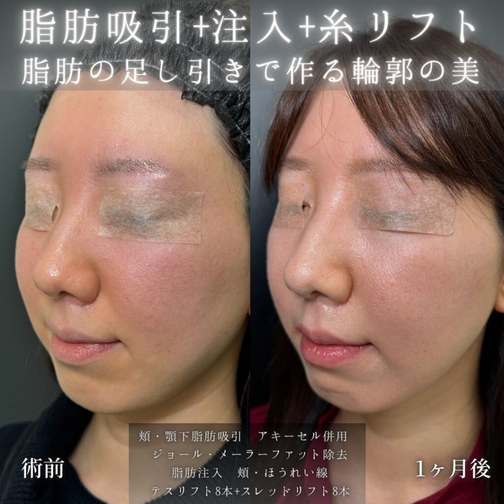 頬と顎下の脂肪吸引とジョールとメーラーファットと脂肪注入と糸リフトの症例写真 (3)