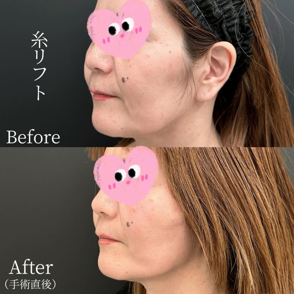 糸リフトの症例写真 (36)