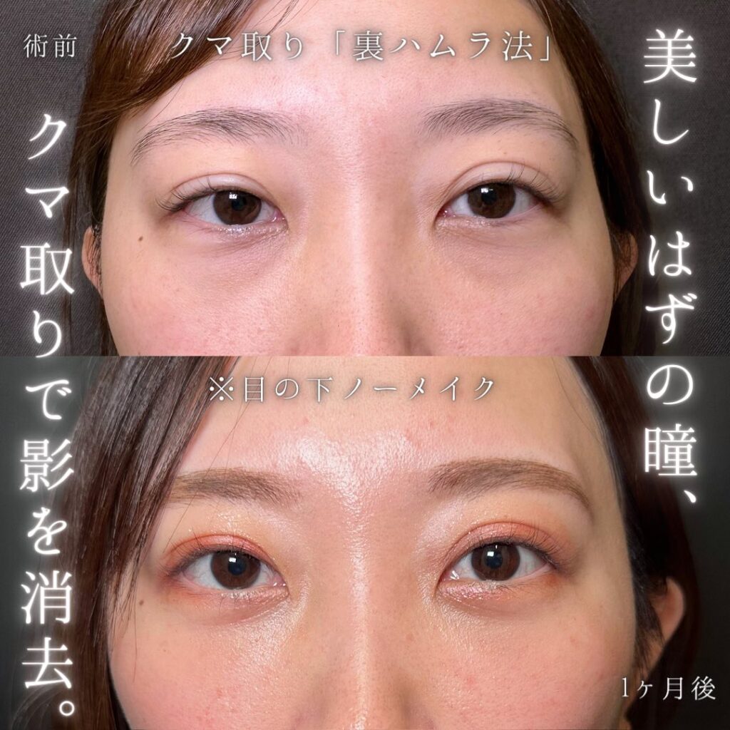 裏ハムラ法の症例写真 (38)