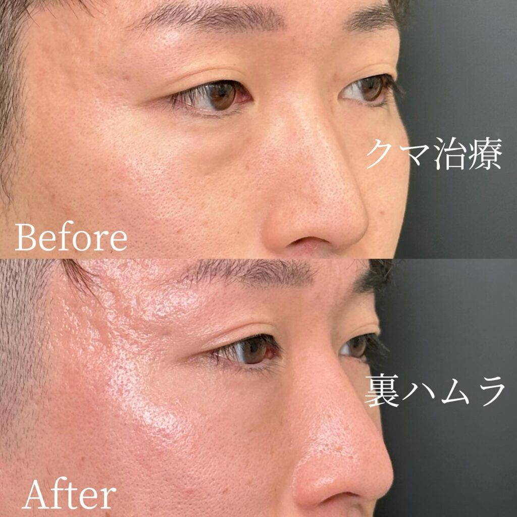 裏ハムラ法の症例写真 (38)