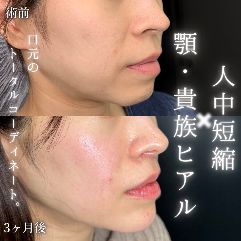 人中短縮と顎、法令線のヒアルロン酸の症例写真 (1)
