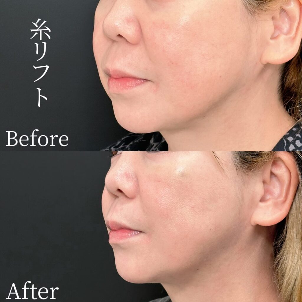 糸リフトの症例写真 (26)