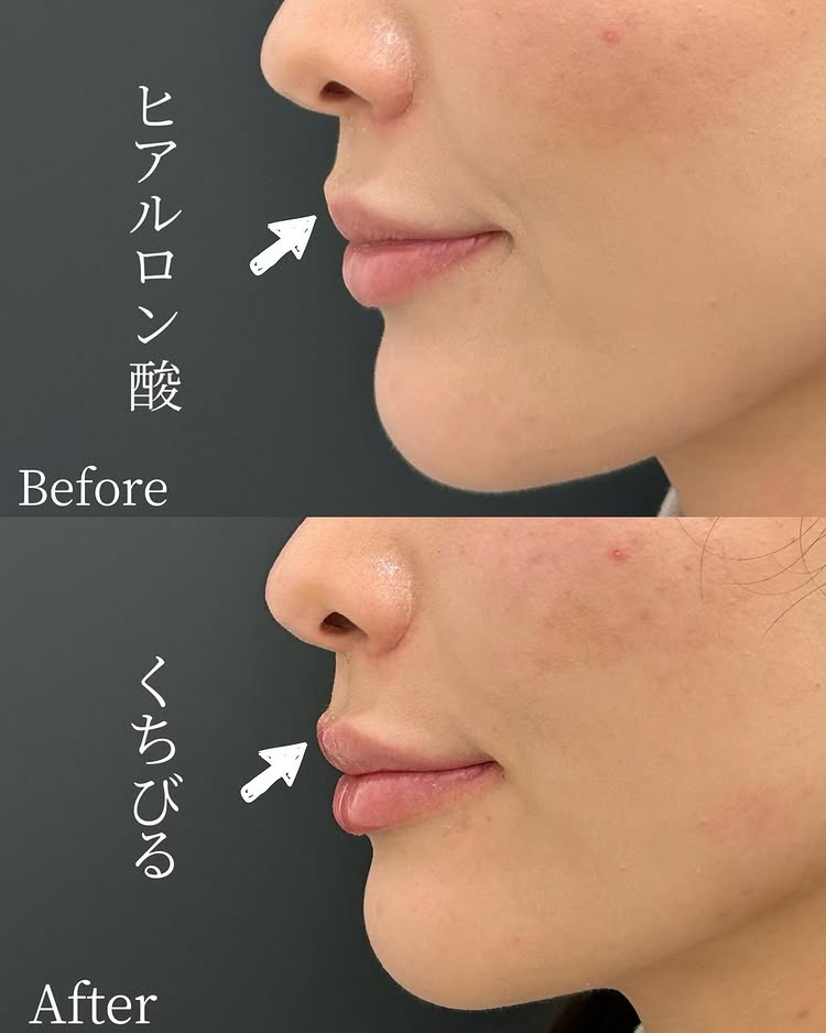 唇のヒアルロン酸の症例写真 (43)
