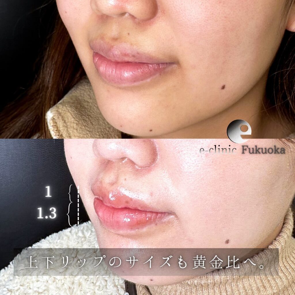 唇縮小の症例写真 (3)