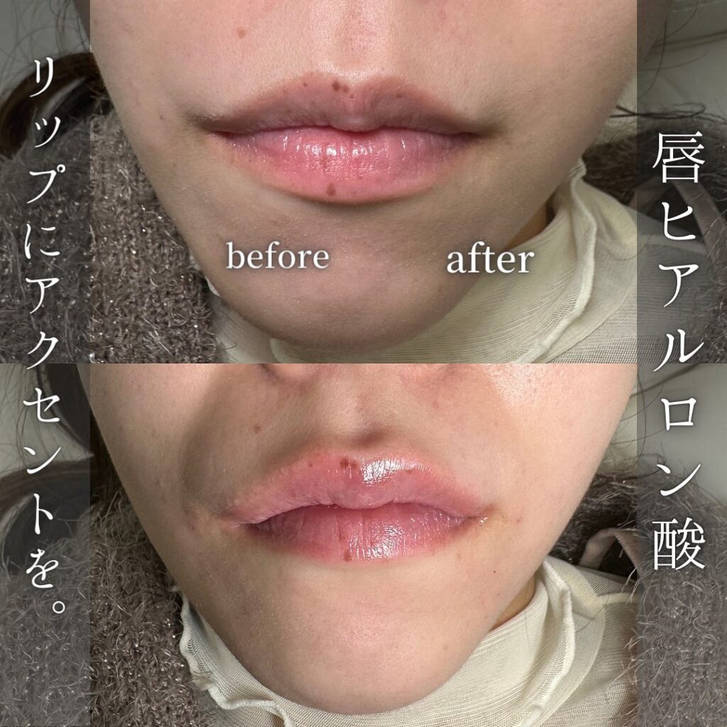 唇のヒアルロン酸の症例写真 (15)