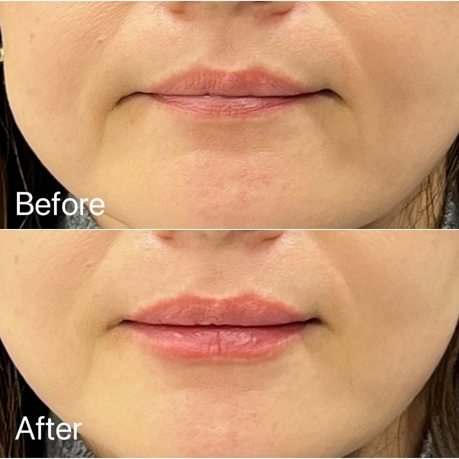 唇のヒアルロン酸の症例写真 (15)