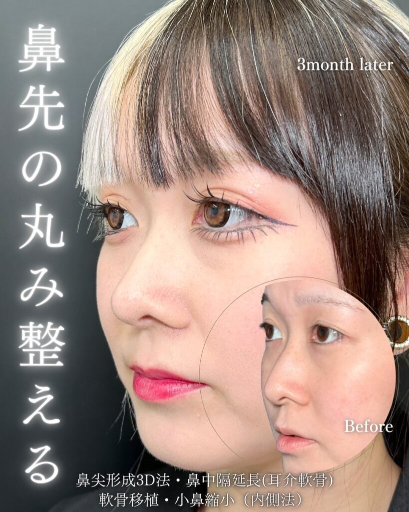 鼻中隔延長と鼻尖形成と軟骨移植と小鼻縮小の症例写真 (4)