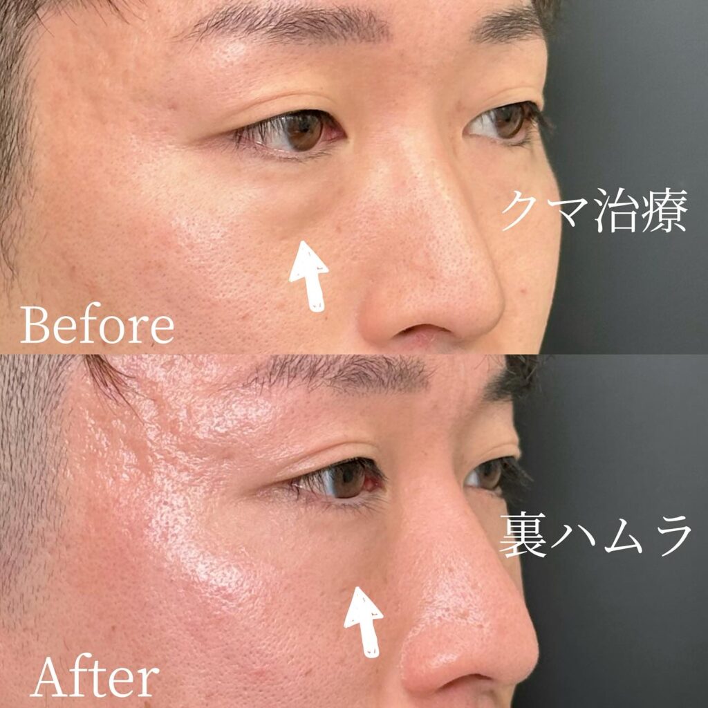 裏ハムラ法の症例写真 (39)