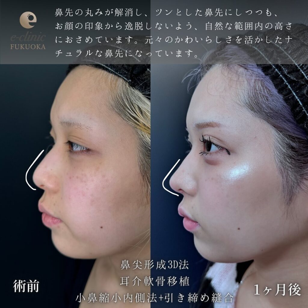 鼻尖形成と耳介軟骨移植と小鼻縮小の症例写真 (2)