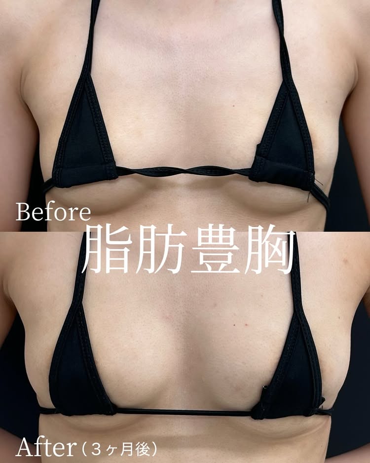 脂肪豊胸の症例写真 (1)