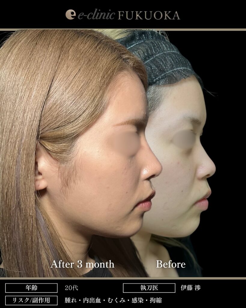 鼻尖形成と軟骨移植と小鼻縮小とプロテーゼの症例写真 (9)