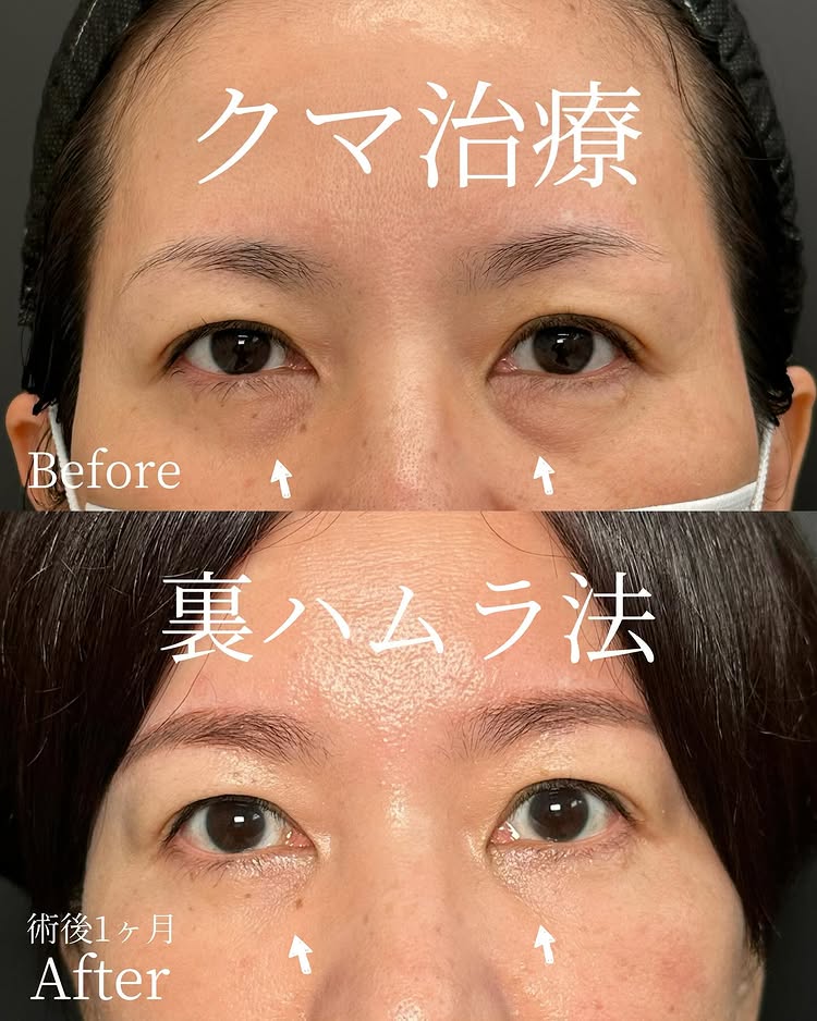 裏ハムラ法の症例写真 (81)