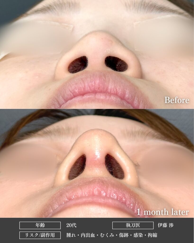 鼻中隔延長と鼻尖形成と軟骨移植とプロテーゼの症例写真 (3)