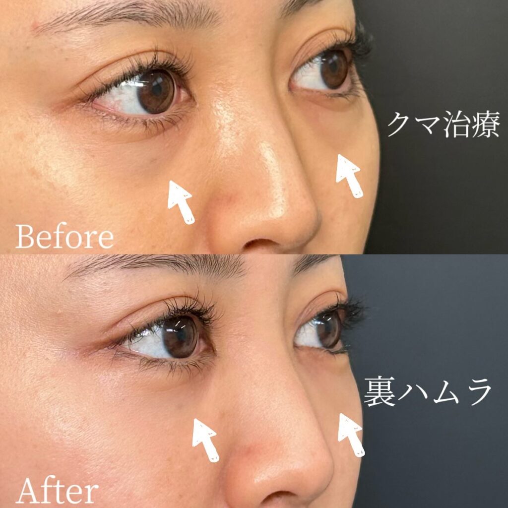 裏ハムラ法の症例写真 (42)