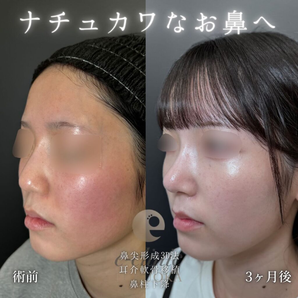 鼻尖形成と耳介軟骨移植と鼻柱下降の症例写真 (3)