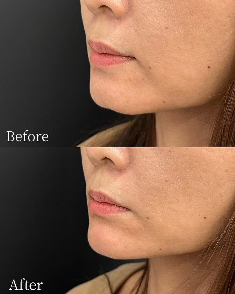 顎のヒアルロン酸の症例写真 (32)