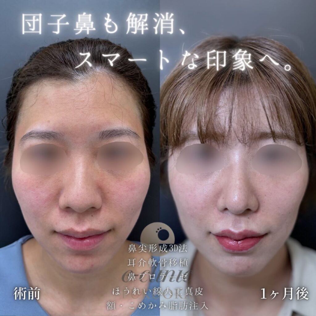 鼻尖形成と軟骨移植とプロテーゼと人工真皮と脂肪注入の症例写真 (2)