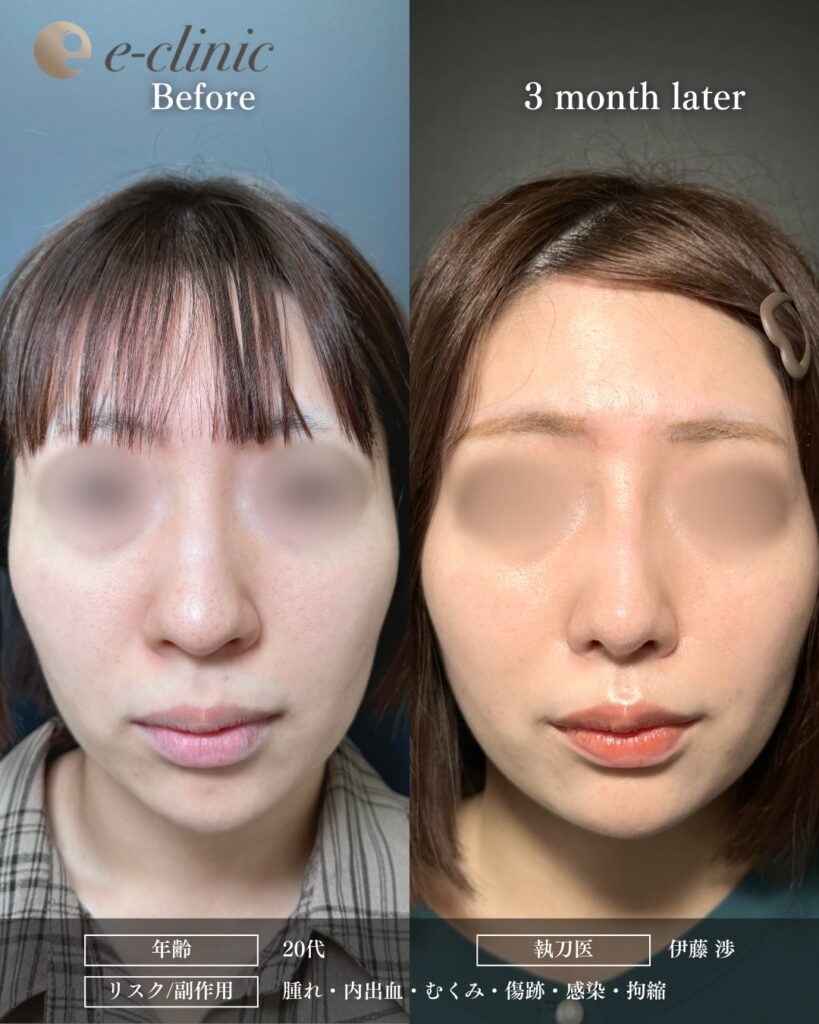 鼻尖形成と軟骨移植とプロテーゼと小鼻縮小の症例写真 (22)